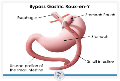 bypass gastric roux loss shown weight